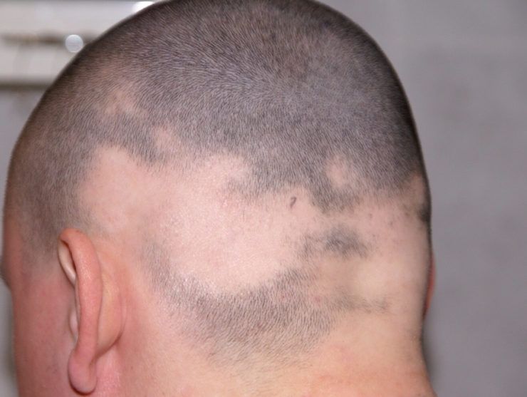 Alopezia Areata