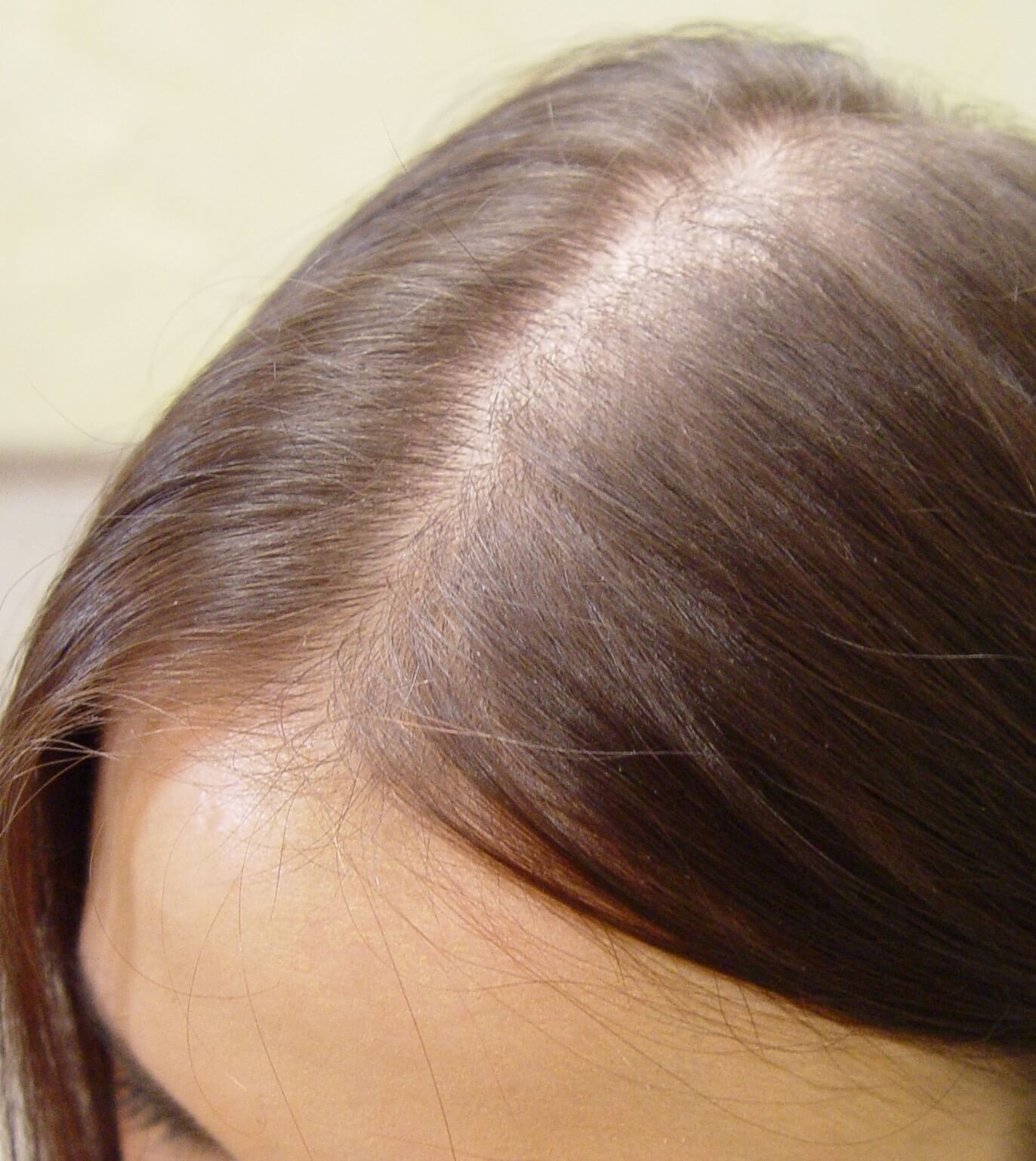 Diffuse Alopezie